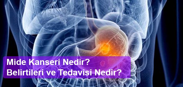  Mide Kanseri Nedir? Belirtileri ve Tedavisi Nedir?